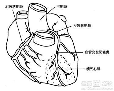 如何判斷自己是否患有冠心病