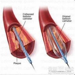 冠心病心肌橋怎麼辦