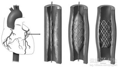 冠心病支架植入術後注意事項