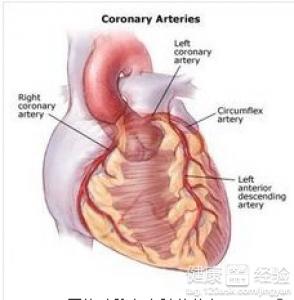 冠心病的患者，如何減少發作呢？