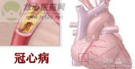 冠心病的臨床症狀及治療