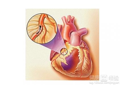 對於冠心病的誤區有哪些？
