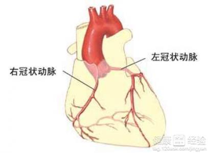 糖尿病合並冠狀動脈狹窄，選擇支架還是搭橋