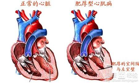 肥厚型心肌病的病因