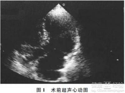 肥厚型梗阻性心肌病的治療方法有哪些？