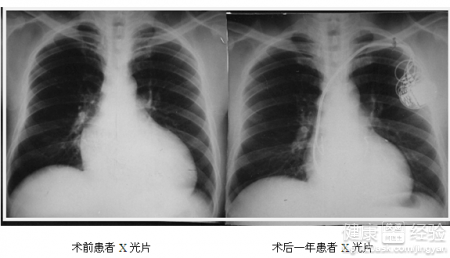 擴張型心肌病的病因是什麼