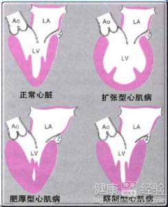 心肌病是怎樣產生的