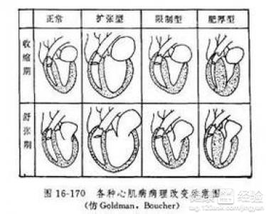 擴張型心肌病需要做手術嗎