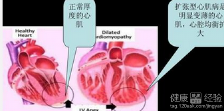 擴張型心肌病病人出現心髒衰竭還有救嗎