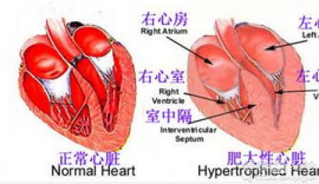 肥厚性心肌病是遺傳的嗎