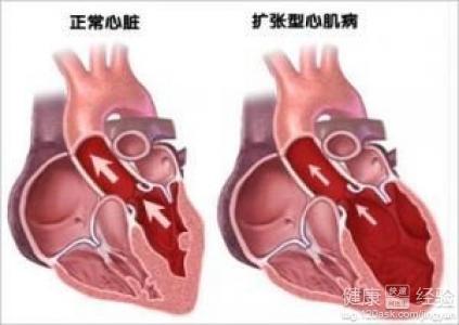 擴張性心肌病應注意那些