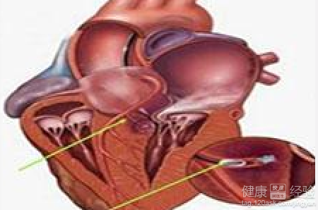 肥厚型心肌病可以治愈嗎