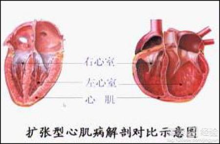 圍產期心肌病的症狀