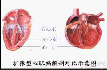 擴張型心肌病飲食應注意什麼