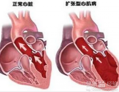 擴張性心肌病能徹底治好嗎