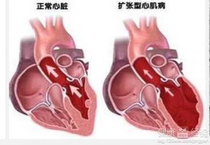 擴張型心肌病可以治好嗎