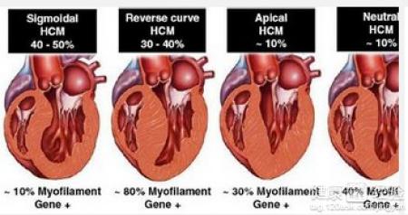 肥厚型心肌病有什麼症狀