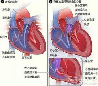 非梗阻性肥厚型心肌病一定要手術嗎