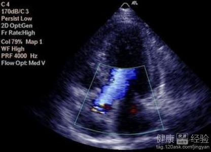 擴張性心肌病有中醫的治療方法嗎