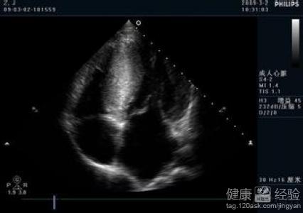 肥厚性非梗阻性心肌病如用中藥治