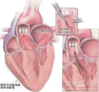 肥厚性梗阻性心肌病通過手術可以治療嗎