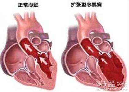 得了擴張型心肌病是會胸悶嗎