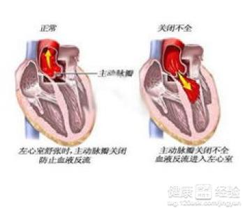 如何預防心肌炎反復