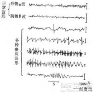 心肌病怎麼辦？？