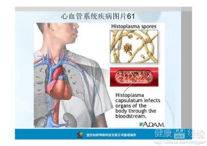 怎樣判斷是否得了急性心功能不全