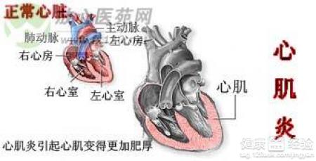 心肌炎的臨床症狀及治療