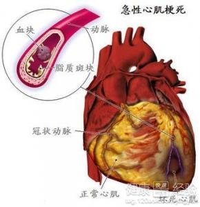 急性心肌梗死的症狀