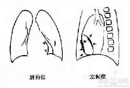 怎樣預防心髒病