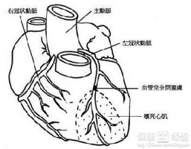 得了心肌病要怎樣進行護理