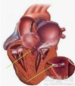 中醫怎樣治療心肌病。