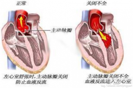 如何預防風濕性心髒病