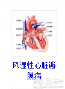 風濕性心髒病引起肺高壓的機率大嗎