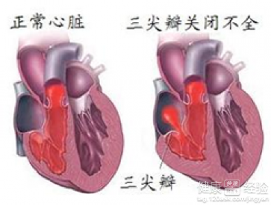 風濕性心髒病二尖瓣三尖瓣關閉不全需要治療嗎