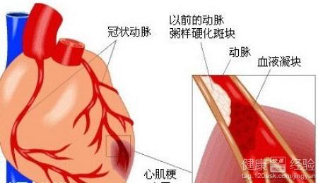 風濕性心髒病換二尖瓣的後遺症有哪些