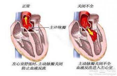 風濕性心髒病二尖瓣術後的保養與注意事項