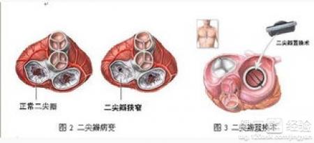 早期風濕性心髒病不治療可以活多久