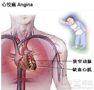 急性心絞痛會引起什麼症狀