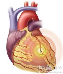 怎樣防止心絞痛