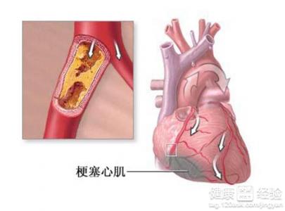 什麼是冠心病和心絞痛