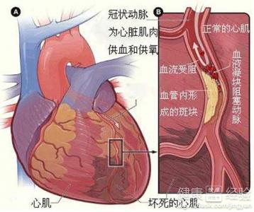 心肌梗死與心絞痛怎樣鑒別