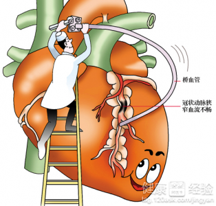 心絞痛有什麼症狀？