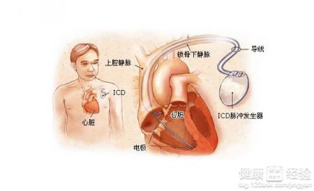 心律失常頻發室怎麼保養