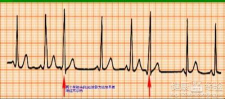 室性早搏如何治療
