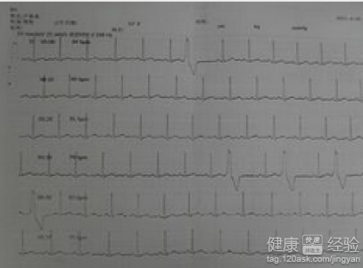 頻發室性早搏的治療危險嗎