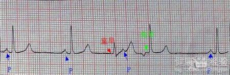 間歇性房性早搏怎麼治
