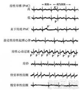 生完孩子後心率不齊早搏怎麼辦